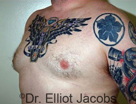 Male breast, after Gynecomastia treatment, l-side oblique view - patient 54