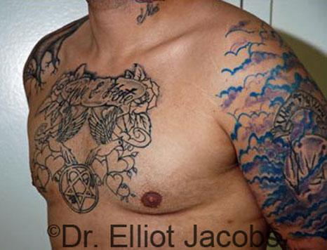 Male breast, after Gynecomastia treatment, l-side oblique view - patient 55