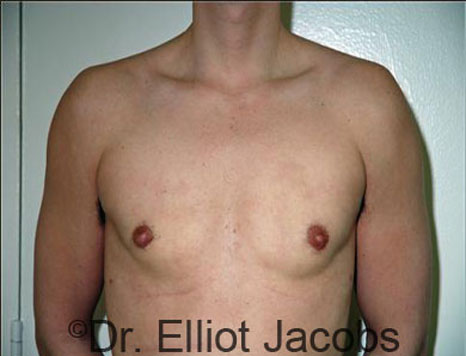 Male breast, after Gynecomastia treatment, front view, patient 56
