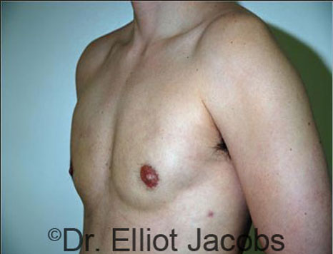 Male breast, after Gynecomastia treatment, l-side oblique view - patient 56