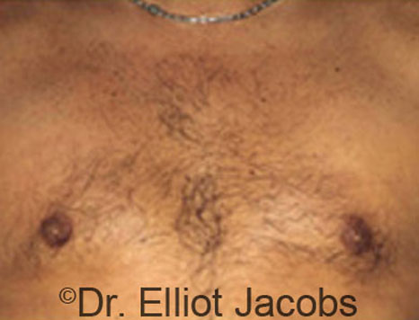 Male breast, after Gynecomastia treatment, front view, patient 57