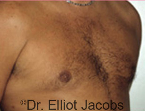Male breast, after Gynecomastia treatment, l-side oblique view - patient 57