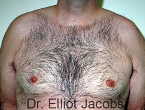 Male breast, after Gynecomastia treatment, front view, patient 58