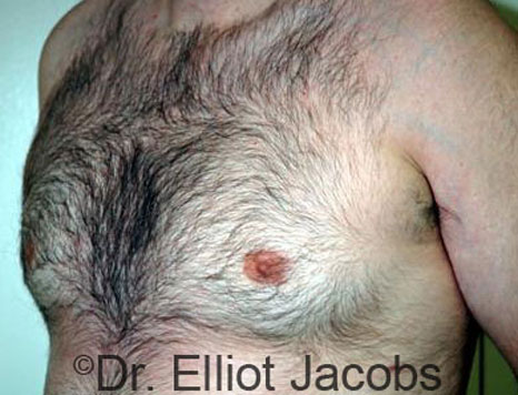 Male breast, after Gynecomastia treatment, l-side oblique view - patient 58