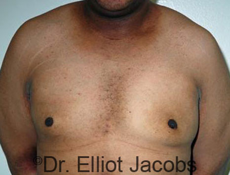 Male breast, after Gynecomastia treatment, front view, patient 59