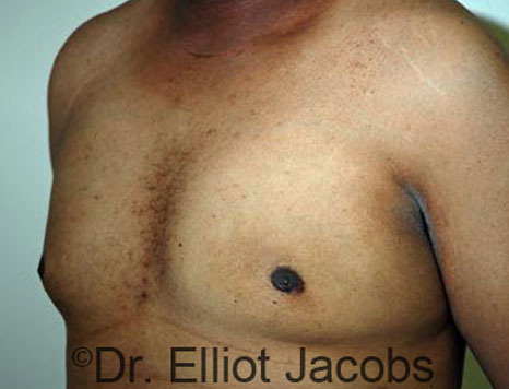Male breast, after Gynecomastia treatment, l-side oblique view - patient 59