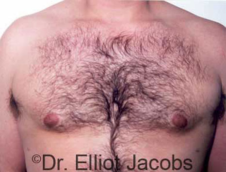 Male breast, after Gynecomastia treatment, front view, patient 6