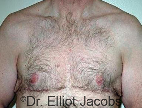 Male breast, after Gynecomastia treatment, front view, patient 60