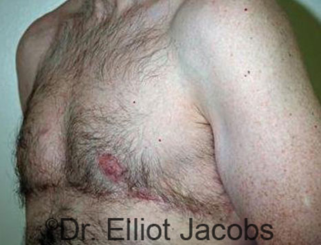 Male breast, after Gynecomastia treatment, l-side oblique view - patient 60