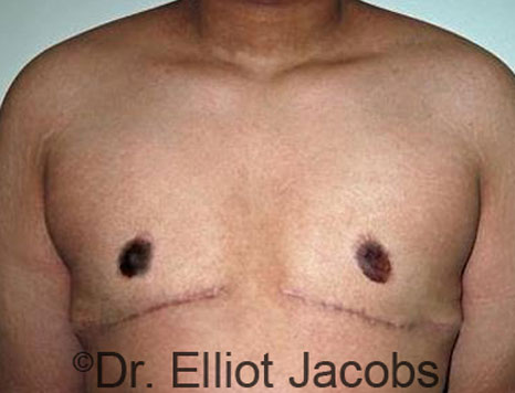 Male breast, after Gynecomastia treatment, front view, patient 61