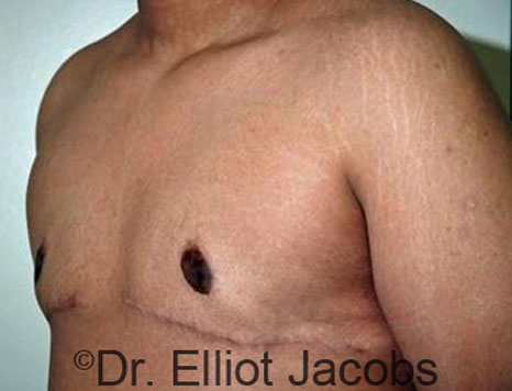 Male breast, after Gynecomastia treatment, l-side oblique view - patient 61