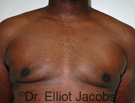 Male breast, after Gynecomastia treatment, front view, patient 62