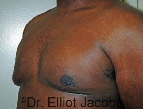 Male breast, after Gynecomastia treatment, l-side oblique view - patient 62