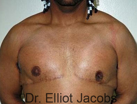 Male breast, after Gynecomastia treatment, front view, patient 63