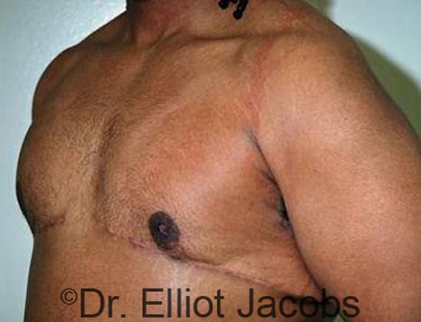 Male breast, after Gynecomastia treatment, l-side oblique view - patient 63