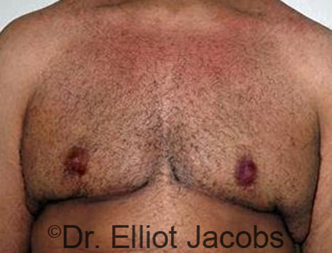 Male breast, after Gynecomastia treatment, front view, patient 64