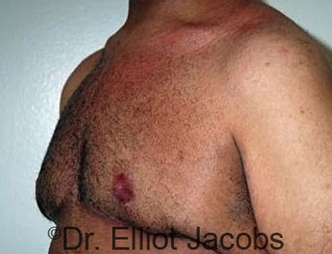 Male breast, after Gynecomastia treatment, l-side oblique view - patient 64
