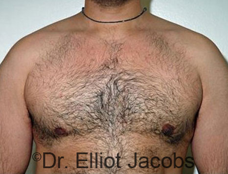 Male breast, after Gynecomastia treatment, front view, patient 65