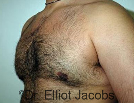 Male breast, after Gynecomastia treatment, l-side oblique view - patient 65