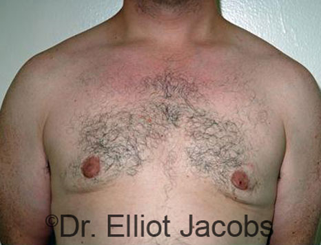 Male breast, after Gynecomastia treatment, front view, patient 66