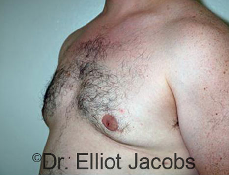 Male breast, after Gynecomastia treatment, l-side oblique view - patient 66