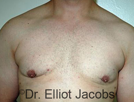 Male breast, after Gynecomastia treatment, front view, patient 67