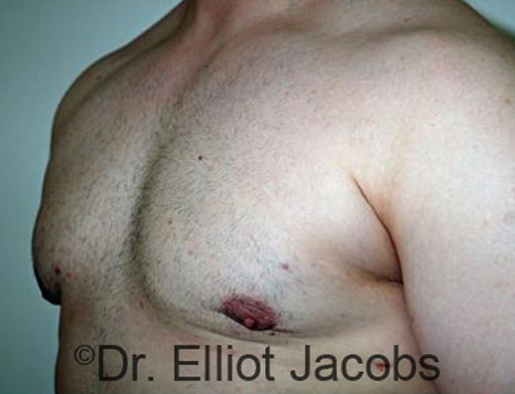 Male breast, after Gynecomastia treatment, l-side oblique view - patient 67
