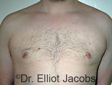 Male breast, after Gynecomastia treatment, front view, patient 68