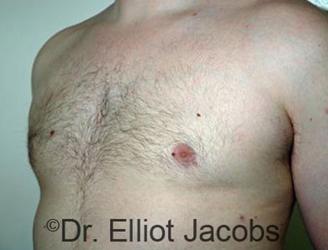Male breast, after Gynecomastia treatment, l-side oblique view - patient 68