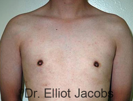 Male breast, after Gynecomastia treatment, front view, patient 69