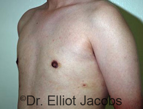 Male breast, after Gynecomastia treatment, l-side oblique view - patient 69