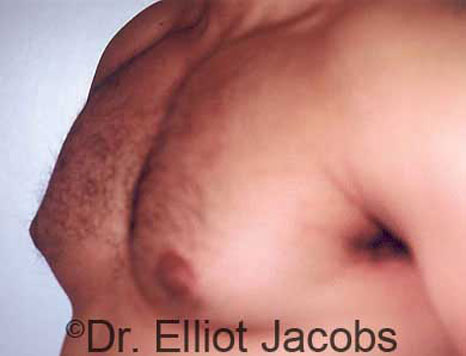 Male breast, after Gynecomastia treatment, l-side oblique view, patient 7