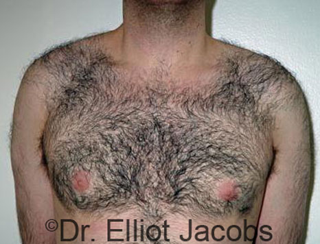 Male breast, after Gynecomastia treatment, front view, patient 70
