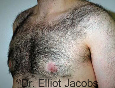 Male breast, after Gynecomastia treatment, l-side oblique view - patient 70