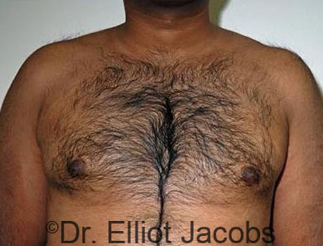 Male breast, after Gynecomastia treatment, front view, patient 71