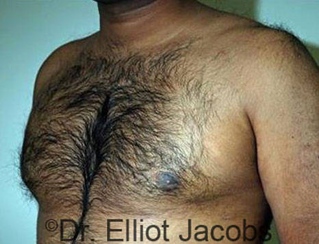 Male breast, after Gynecomastia treatment, l-side oblique view - patient 71