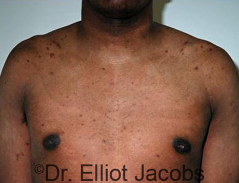 Male breast, after Gynecomastia treatment, front view, patient 72