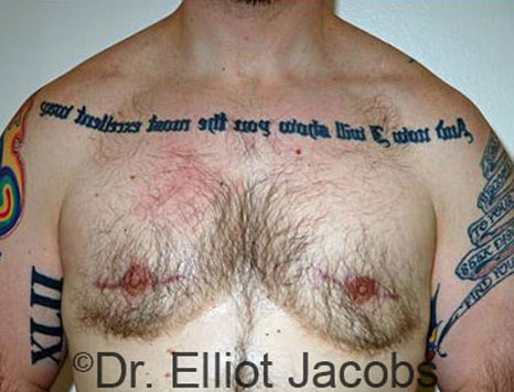 Male breast, after Gynecomastia treatment, front view, patient 73