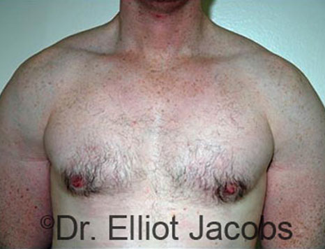 Male breast, after Gynecomastia treatment, front view, patient 74