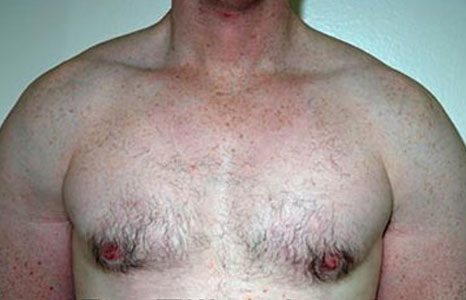 Male breast, after gynecomastia treatment, front view, patient 74
