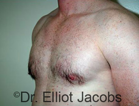 Male breast, after Gynecomastia treatment, l-side oblique view - patient 74