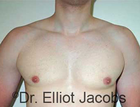 Male breast, after Gynecomastia treatment, front view, patient 75