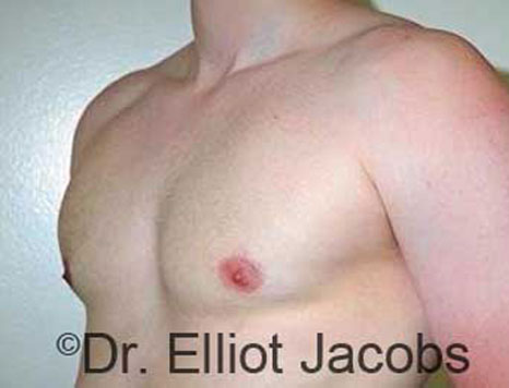 Male breast, after Gynecomastia treatment, l-side oblique view - patient 75