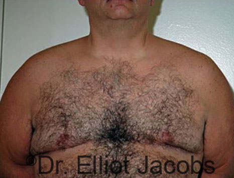 Male breast, after Gynecomastia treatment, front view, patient 76