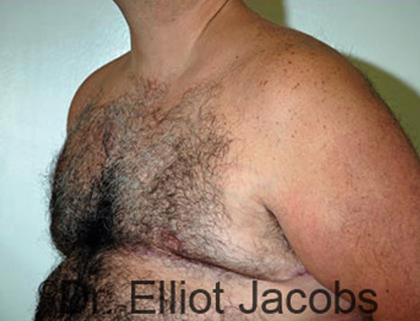 Male breast, after Gynecomastia treatment, l-side oblique view - patient 76