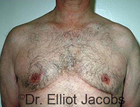 Male breast, after Gynecomastia treatment, front view, patient 77