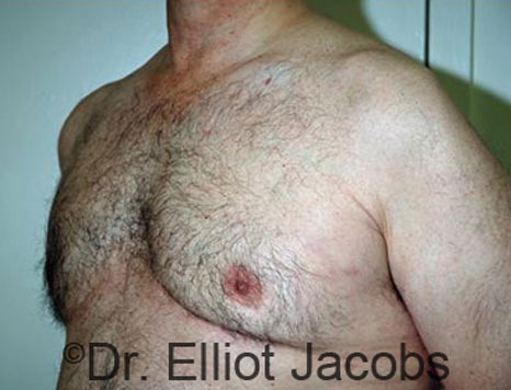 Male breast, after Gynecomastia treatment, l-side oblique view - patient 77