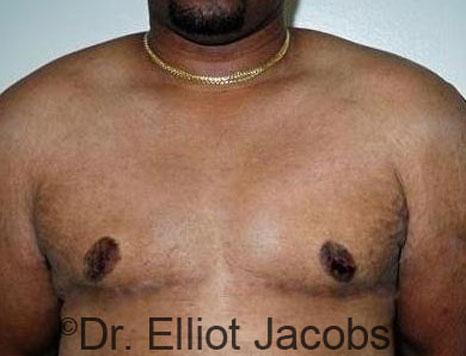 Male breast, after Gynecomastia treatment, front view, patient 78