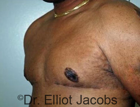 Male breast, after Gynecomastia treatment, l-side oblique view - patient 78