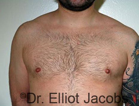 Male breast, after Gynecomastia treatment, front view, patient 79